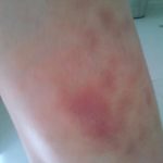 Bruises on my leg from rehersal