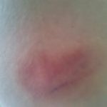 Heart shaped bruise on my ass