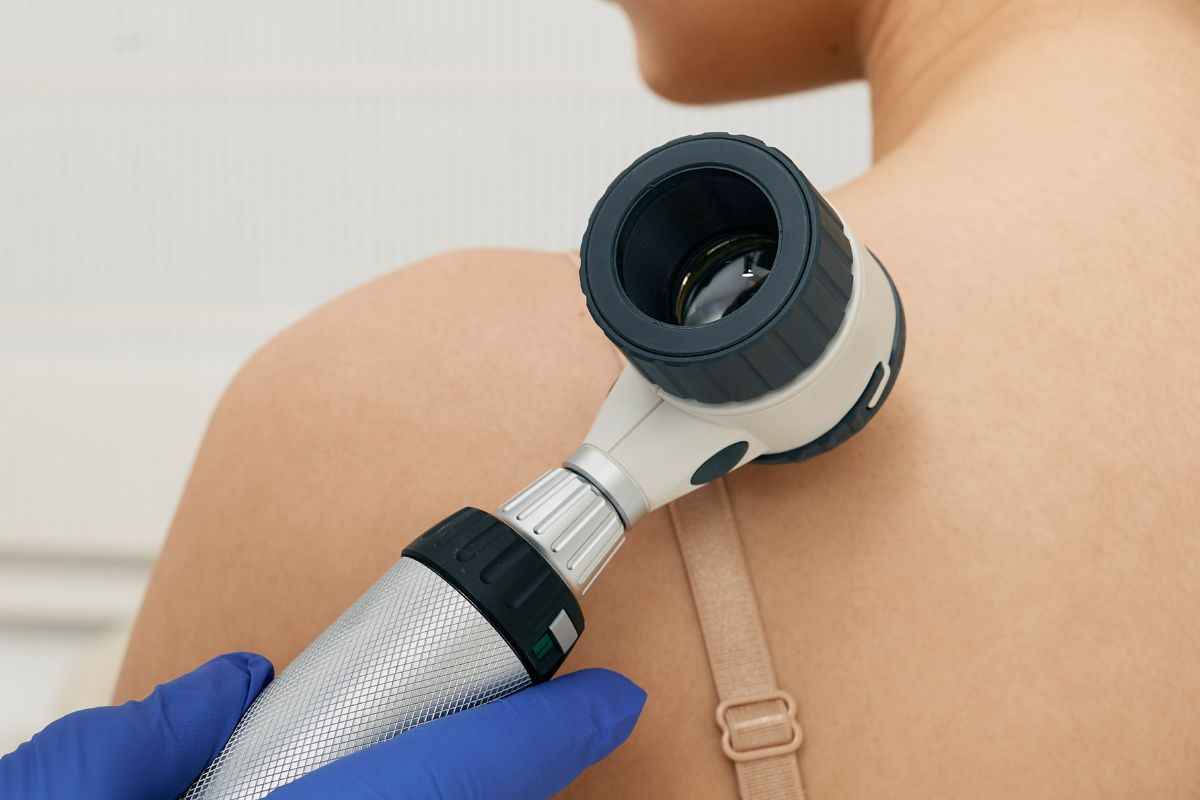 cancro della pelle: fattori di rischio