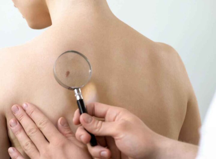 cancro della pelle: fattori di rischio