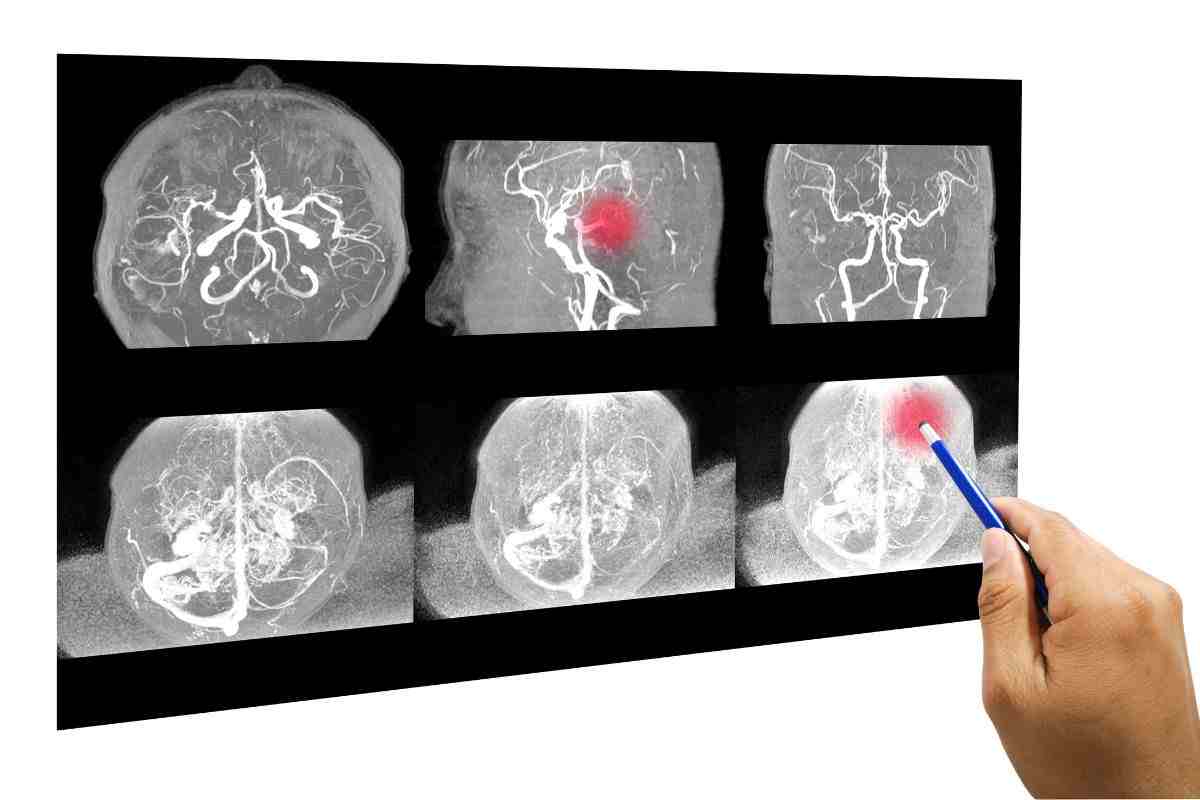 ischemia cerebrale: che cos'è e quali sono i sintomi