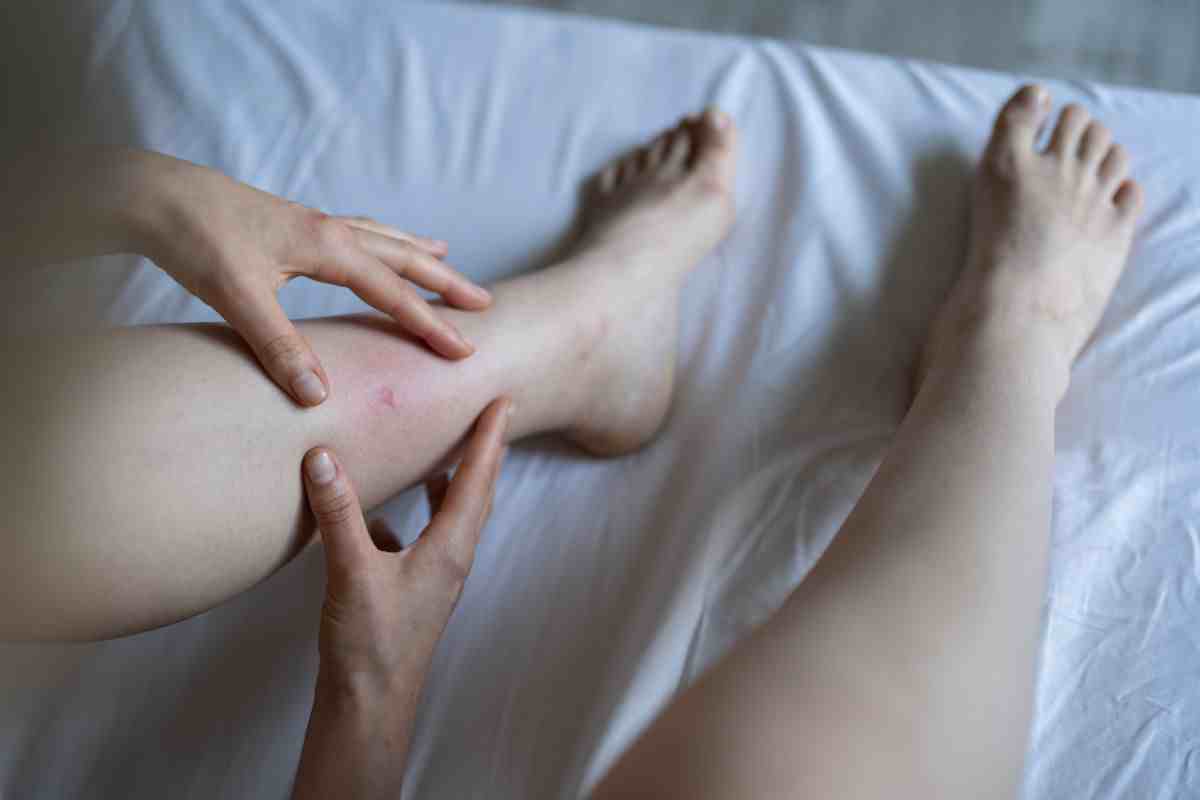 hai spesso prurito alle gambe? potrebbe essere sclerosi multipla